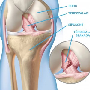 Meniscus sérülés és kezelése Térdízületen szakadt szalagok kezelése